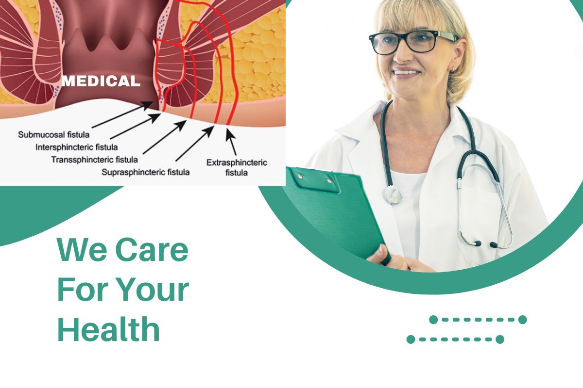 Fistula Causes, Symptoms, Treatment, and Prevention
