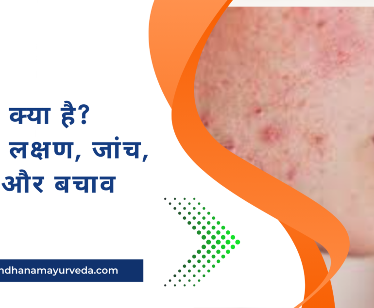 Acne क्या है? कारण, लक्षण, जांच, इलाज और बचाव