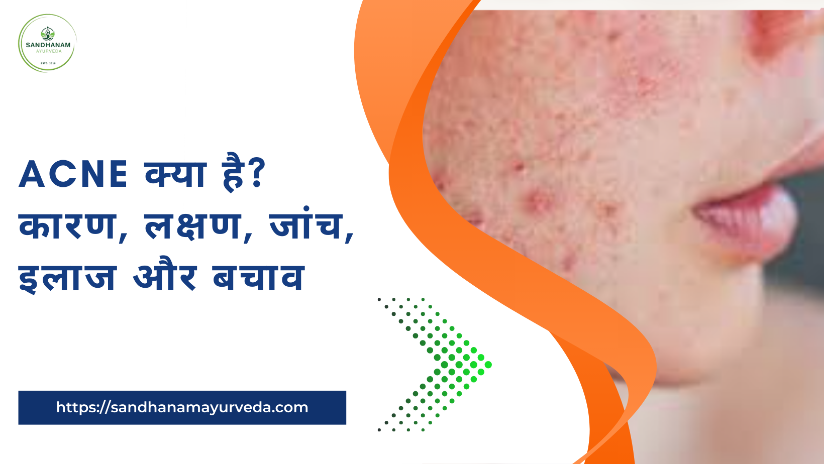Acne क्या है? कारण, लक्षण, जांच, इलाज और बचाव