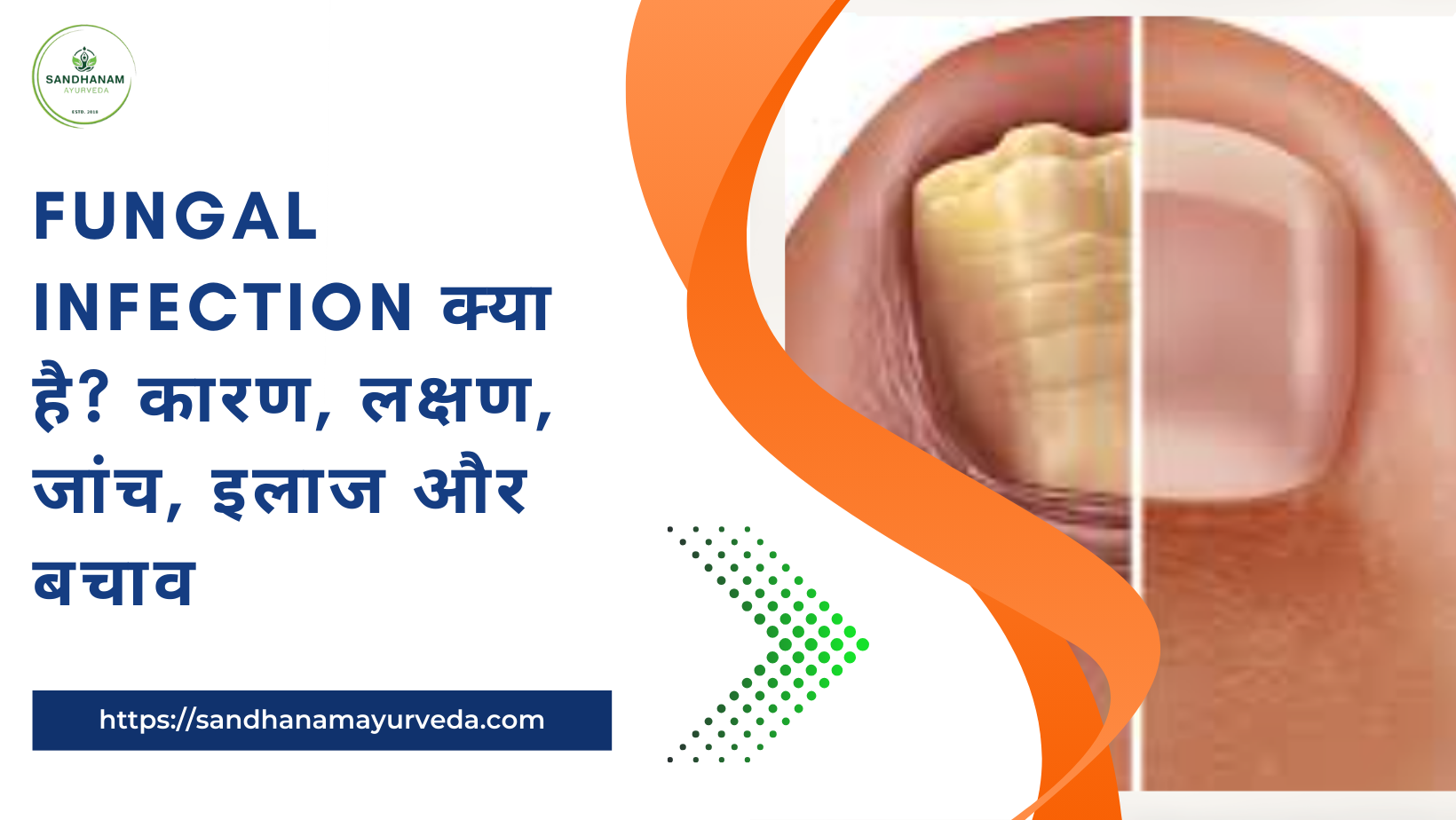 Fungal infection क्या है? कारण, लक्षण, जांच, इलाज और बचाव