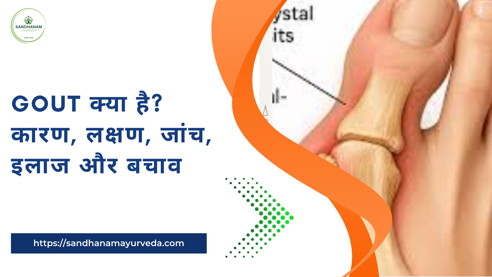 Gout क्या है? कारण, लक्षण, जांच, इलाज और बचाव