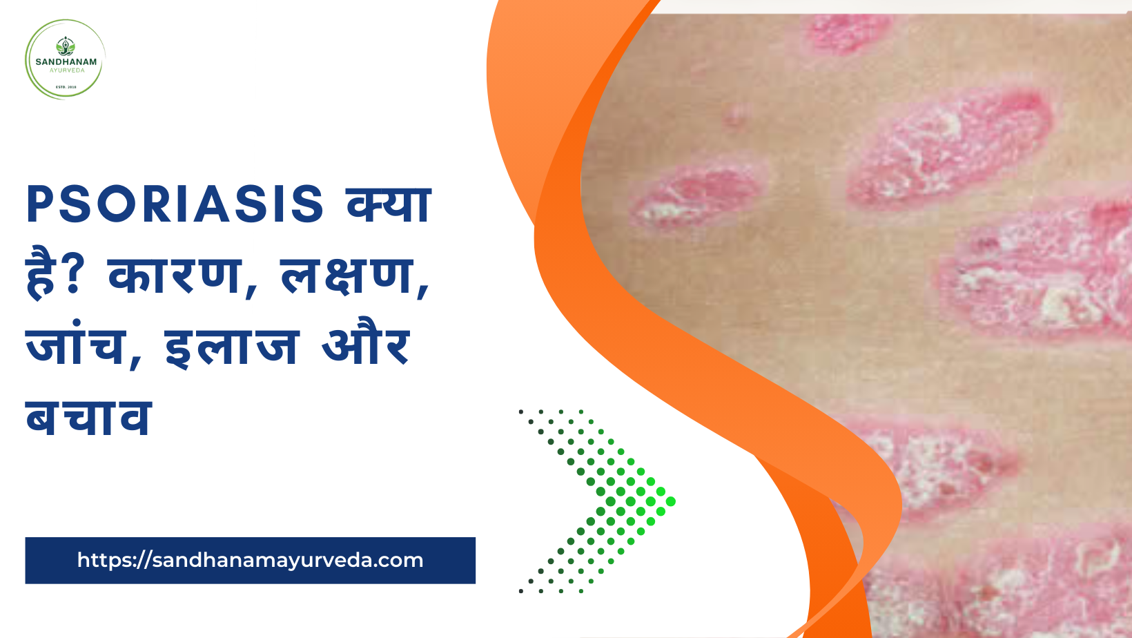 Psoriasis क्या है कारण, लक्षण, जांच, इलाज और बचाव