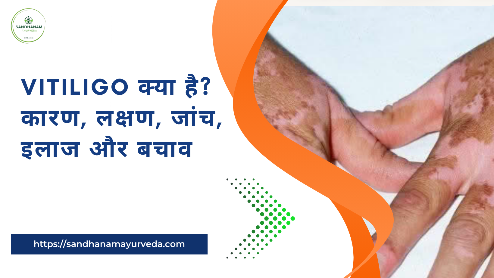 Vitiligo क्या है? कारण, लक्षण, जांच, इलाज और बचाव